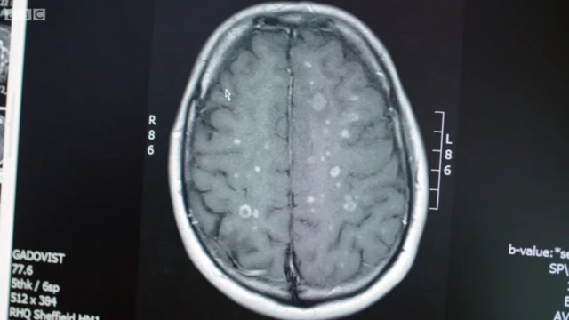 Escáner cerebral de Stephen Storey previo al tratamiento con células madre.