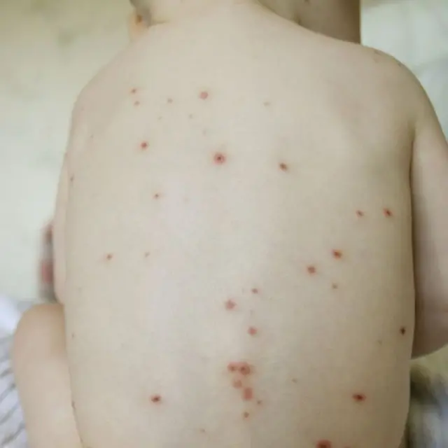 Trong khi hầu hết các trường hợp bị thủy đậu không nghiêm trọng nhưng một số trường hợp có thể gây đe dọa tính mạng.