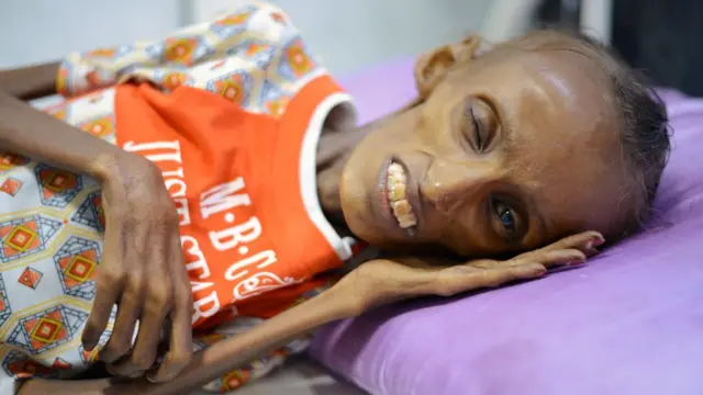 Saida Ahmad Baghili en la cama de un hospital en Yemen.