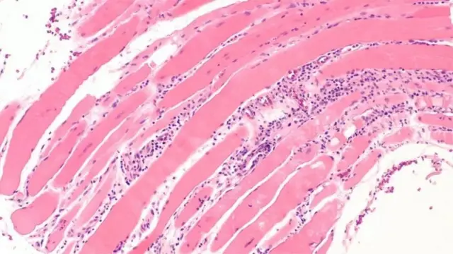 આ બીમારીમાં શરીર પર ફોલ્લી પડી જાય છે