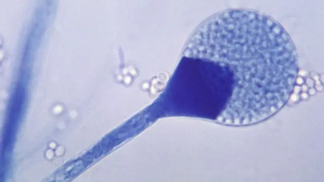 મ્યુકરમાઇકૉસિસ માટે જવાબદાર ફૂગનો ફોટોમાઇક્રૉગ્રાફ