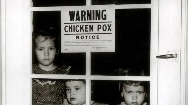 قد يتسبب الأشخاص الذين تلقوا التطعيمات في نشر مرض النكاف الذي تسبب في جوائح في العصر الفيكتوري