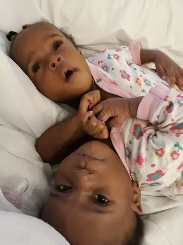 అవిభక్త కవలలు