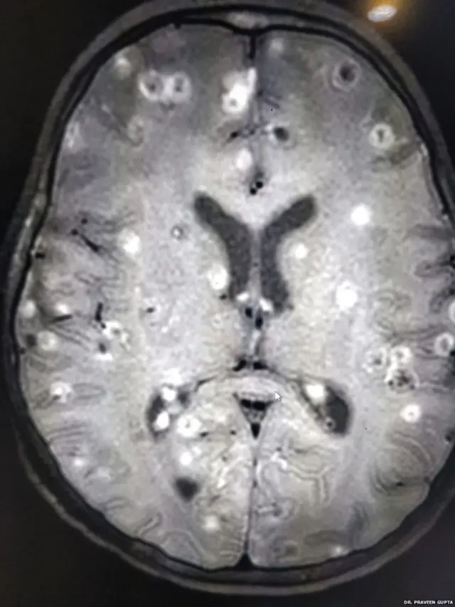 બાળકીના મસ્તકમાં સિટી સ્કેનમાં જોવા મળેલાં કૃમિનાં ઈંડા