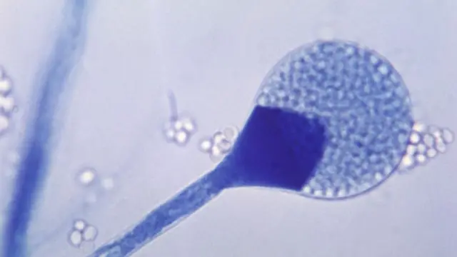 म्युकर मायकोसिस