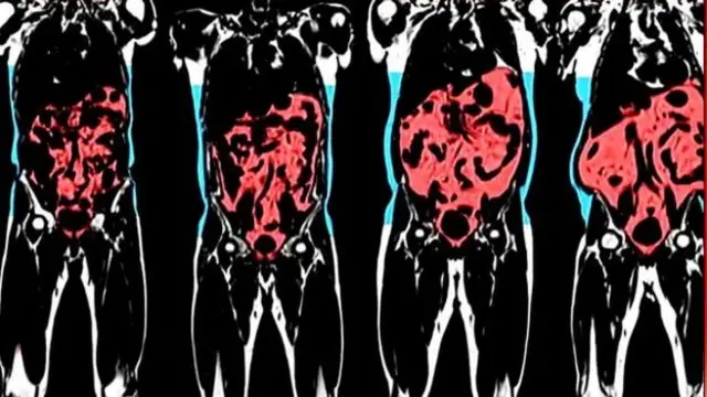内脏脂肪更危险