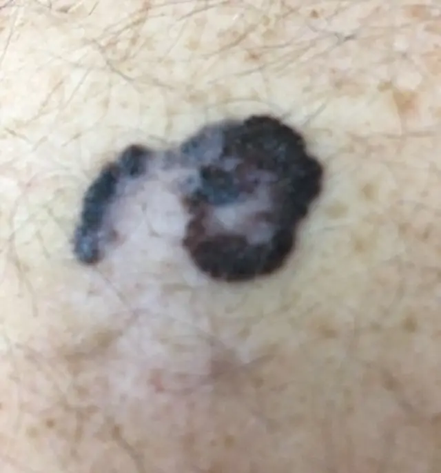 Câncer do tipo melanoma