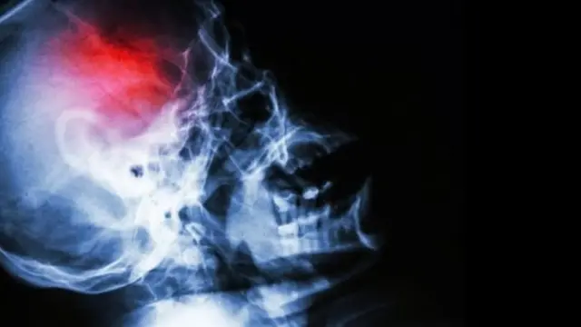 স্ট্রোকে আক্রান্ত হচ্ছে বহু মানুষ