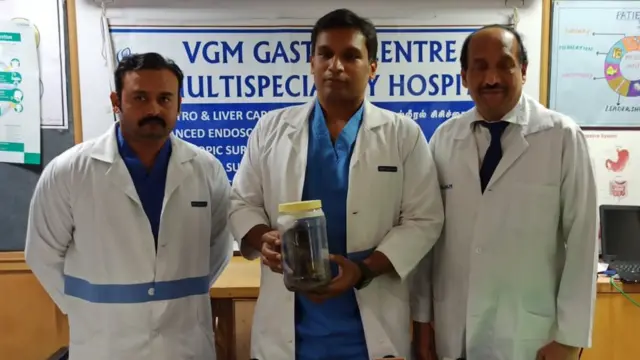 சிறுமியின் வயிற்றிலிருந்து எடுக்கப்பட்ட முடியுடன் மருத்துவர்கள்