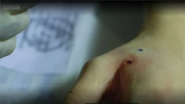 এভাবেই হাতে একটি ছোট ফুটো করে ঢোকানো হয় চিপটি