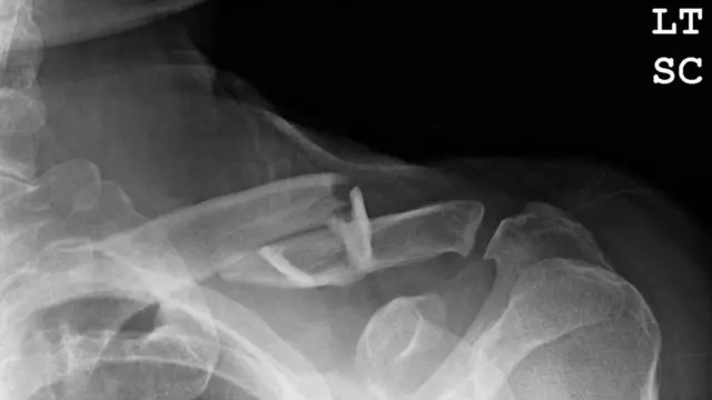 tulang, dokter, patah, kesehatan