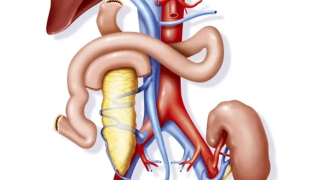 Transplatacija bubrega i pankreasa