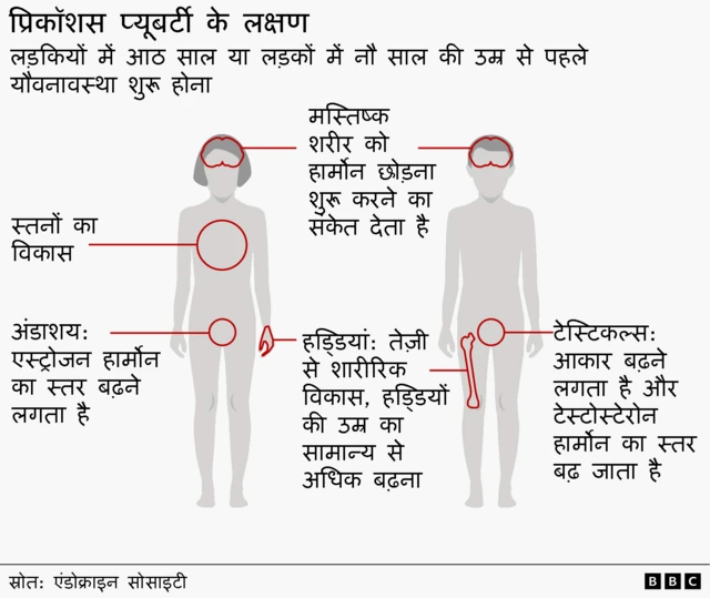 एक पुरुष और एक महिला के शरीर का चित्र बच्चों में समय से पहले यौवनारंभ के लक्षणों को दर्शाता है.