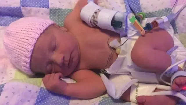 Emilie em UTI neonatal após nascer prematura