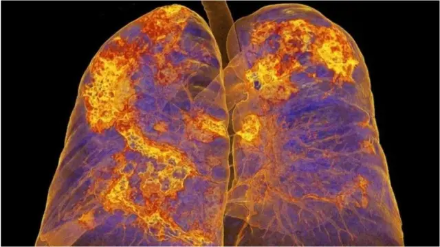 কোভিড-১৯ আক্রান্ত রোগীর ফুসফুসে নিউমোনিয়ার চিহ্ন