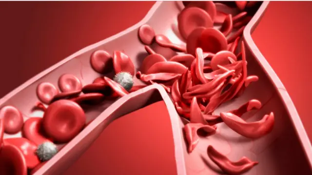 Artwork showing normal red blood cells (round), and red blood cells affected by sickle cell anaemia (crescent shaped).