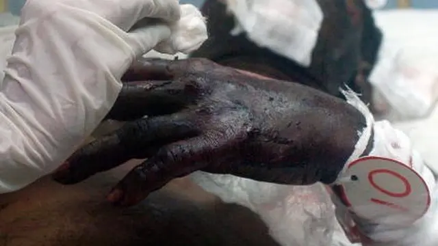 Sri Lanka attacks: doctors' experience