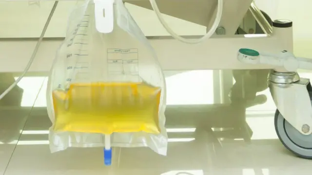 Mfuko wa mkojo unaowekewa mgonjwa aliyelazwa hospitalini