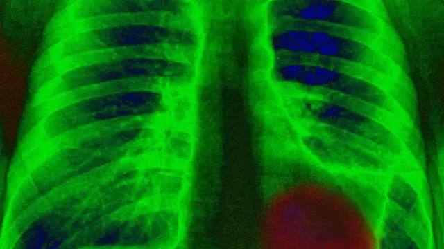 Le cancer du poumon est l'un des plus fréquents dans le monde, aux côtés du cancer du sein et du cancer de l'intestin.