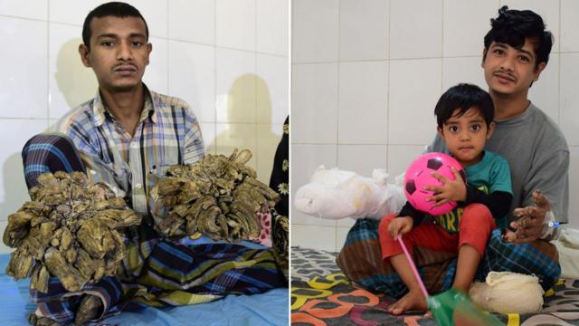 Abul Bajandar antes e depois das cirurgias para a retirada das cascas que se desenvolveram em suas mãos