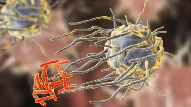 Kifua kikuu husababishwa na bakteria aitwaye Mycobacterium