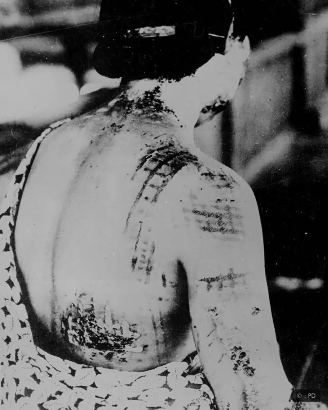 povrede posle nuklearne bombe