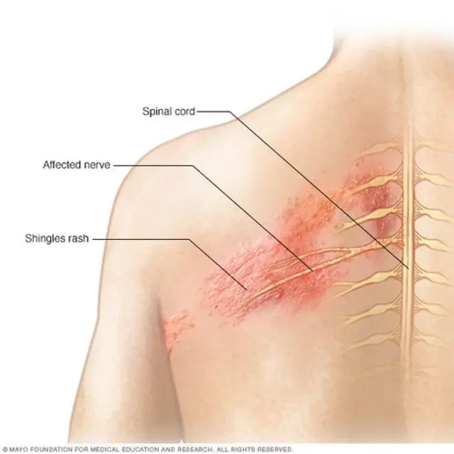 Imagen cortesía de la Clínica Mayo.