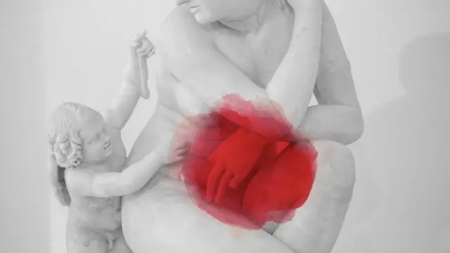 Ендометріоз