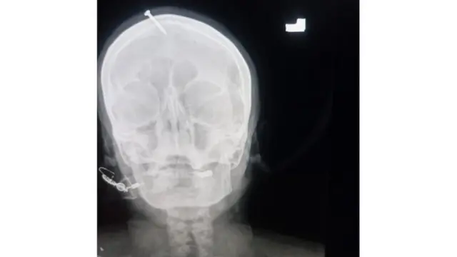 Picha ya X ray inaonyesha msumari uliokwama kwenye kichwa cha mwanamke