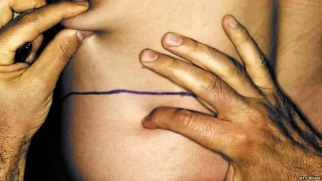 लिपोसक्शन