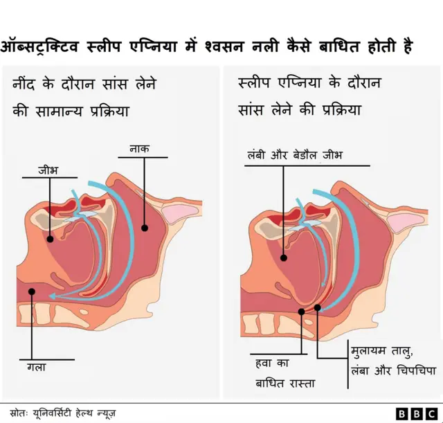 स्लीप एप्निया