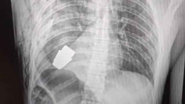 ఛాతిలో గ్రెనెడ్