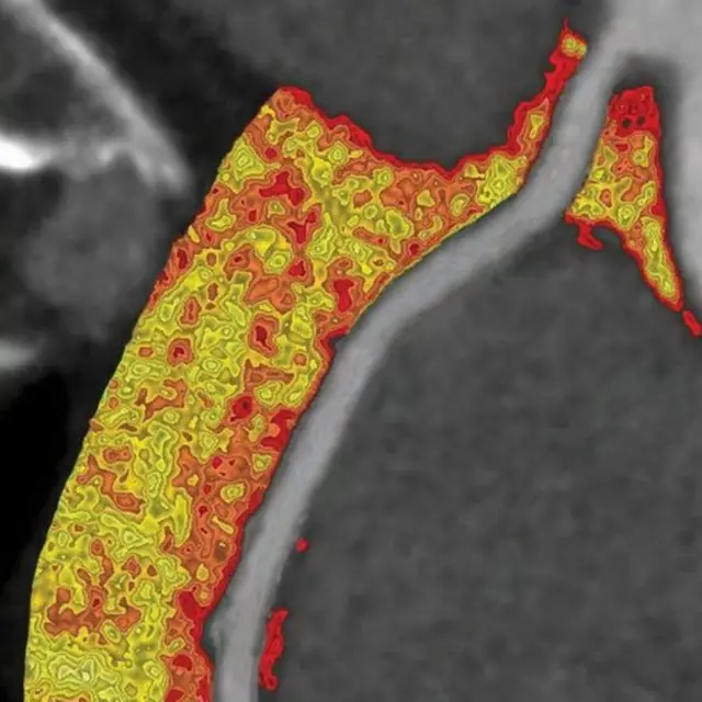 पहले ही पता चल जाएगा कि आपको आ सकता है हार्ट अटैक