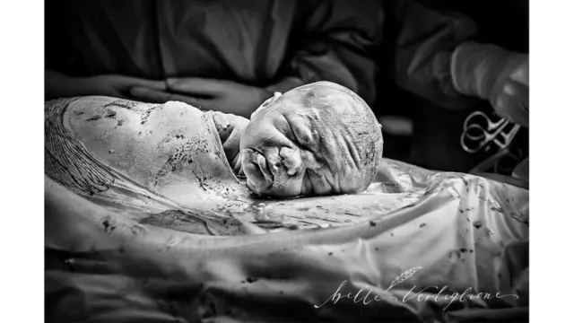 Mención especial: "Nacimiento delicado por cesárea", de Belle Verdiglione Photography