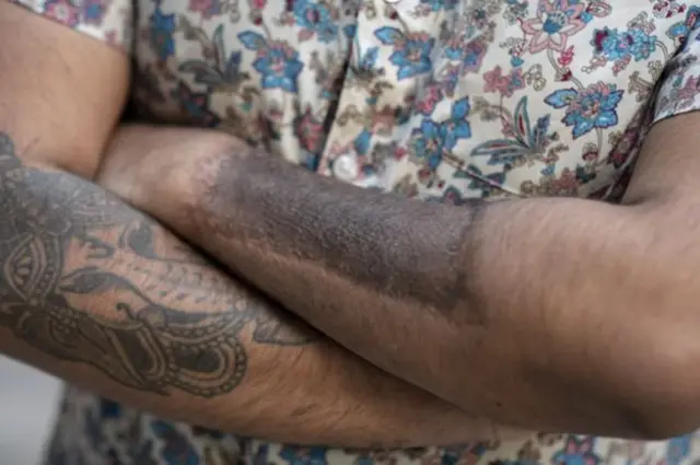 Yalangoch anoreksiya