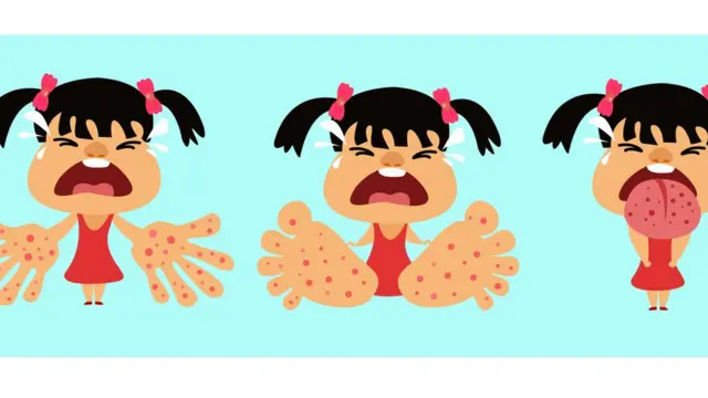 হ্যান্ড ফুট অ্যান্ড মাউথ ডিজিজ