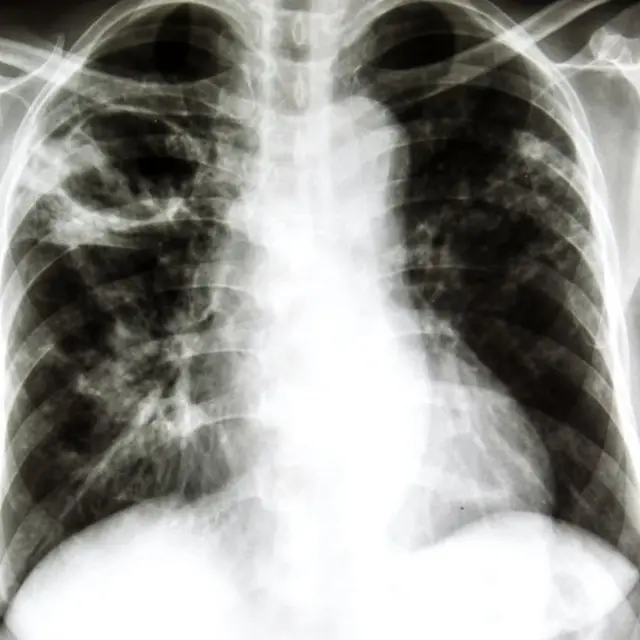 Одно из исследований показало, что витаминные добавки не только не защищают от болезней, но и повышают уровень заболеваемости раком среди курильщиков