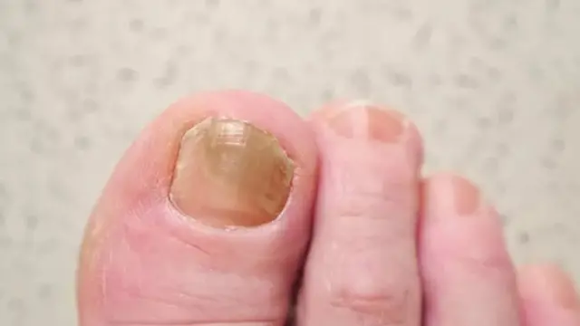 नखं, आरोग्य