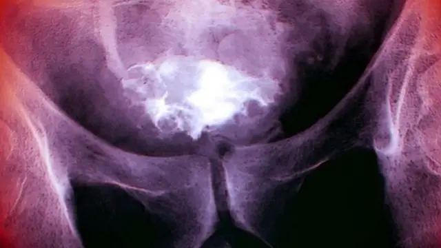 Ренгтенівський знімок пацієнта