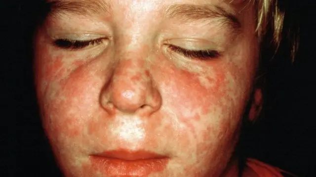 হাম আক্রান্ত এক শিশু।