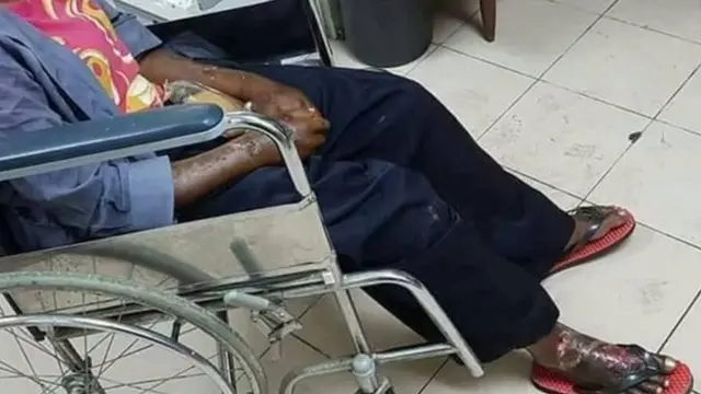 Luka-luka yang diderita Adelina, tangan dan kaki penuh dengan luka bakar.