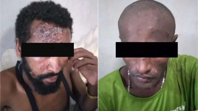 በእስር ቤቱ በተስፋፋው የቆዳ በሽታ ብዙዎቹ ተጠቅተዋል