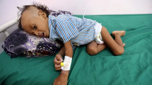 Yemen'de yetersiz beslenmeden hastanede tedavi gören bir çocuk