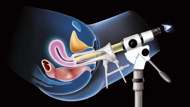 Illustration d'une colposcopie vaginale, examen du col de l'utérus réalisé avec un spéculum et un colposcope. Cet examen est réalisé en complément d'un frottis lorsque le texte du frottis présente des anomalies ou semble inhabituel