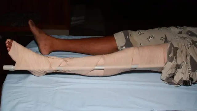 Pressure immobilisation technique