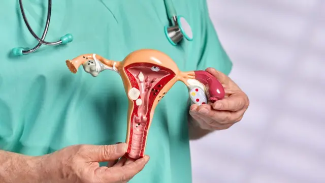 எண்டோமெட்ரியோசிஸ், இனப்பெருக்க வயதில் உள்ள 10 பெண்களில் ஒருவரை பாதிக்கும் என மதிப்பிடப்பட்டுள்ளது