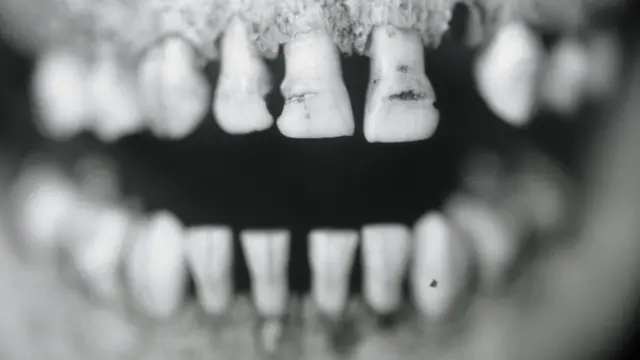 பழங்கால மனிதரின் பற்கள் - மாதிரிப் படம்