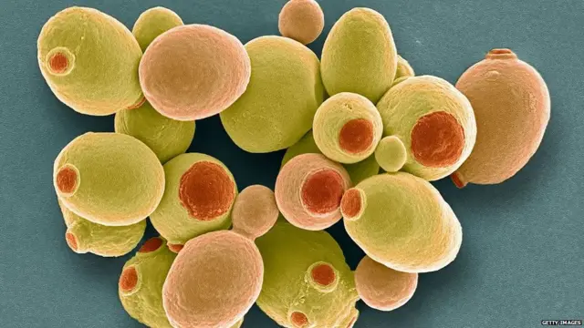 ਆਟੋ-ਬ੍ਰਿਉਰੀ ਸਿੰਡਰੋਮ