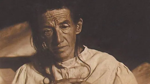 Auguste Deter est devenu le premier malade d'Alzheimer au monde.