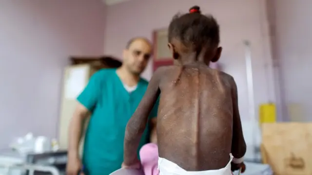 کودک قحطی زده یمنی